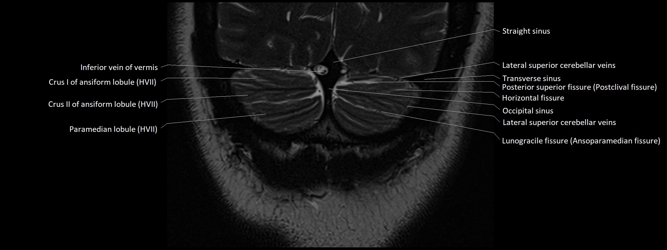 Anatomy of cerebellum coronal cross sectional 3T image 29.webp